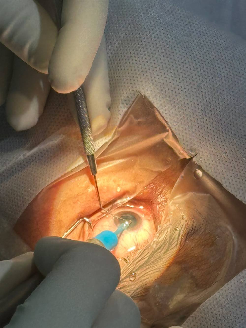 Close-up view of a phaco cataract surgery procedure in progress